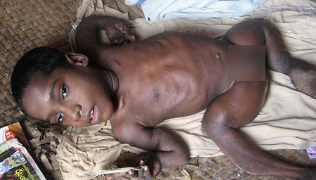 A child suspected to be victim of endosulfan spraying in Kasaragod district- photo RM